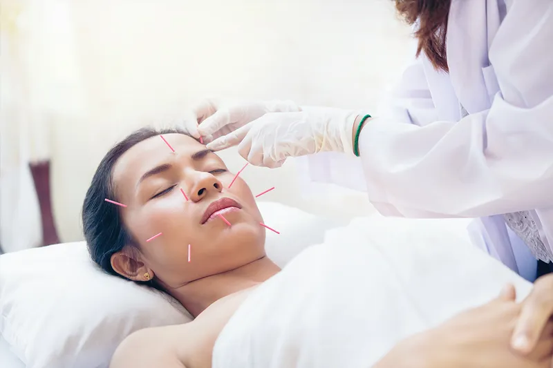 Hilft Akupunktur Frauen in den Wechseljahren gegen Depressionen?