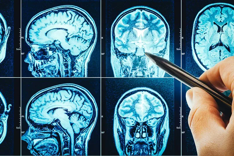 Verändert sich nach einer Behandlung von Depression etwas im Gehirn der Betroffenen?